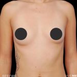 Breast Augmentation Before & After Patient #2753