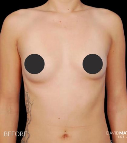 Breast Augmentation Before & After Patient #2753