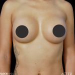 Breast Augmentation Before & After Patient #2753