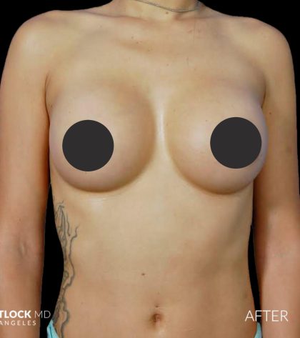 Breast Augmentation Before & After Patient #2753
