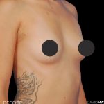 Breast Augmentation Before & After Patient #2753