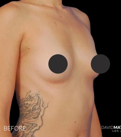 Breast Augmentation Before & After Patient #2753