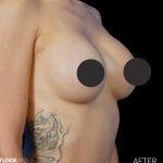 Breast Augmentation Before & After Patient #2753