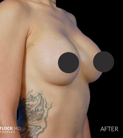 Breast Augmentation Before & After Patient #2753