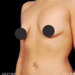Breast Augmentation Before & After Patient #2754