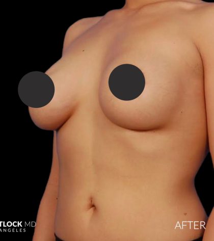 Breast Augmentation Before & After Patient #2754