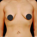 Breast Augmentation Before & After Patient #2754