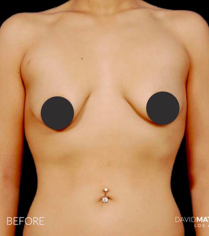 Breast Augmentation Before & After Patient #2754