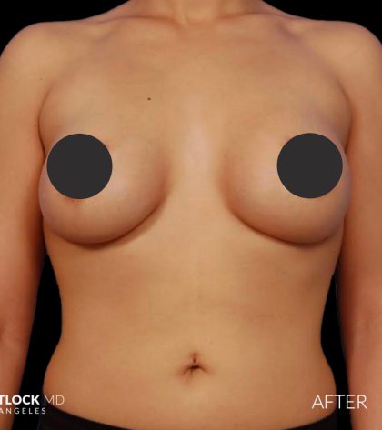 Breast Augmentation Before & After Patient #2754
