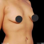 Breast Augmentation Before & After Patient #2754
