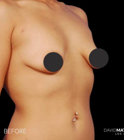 Breast Augmentation Before & After Patient #2754