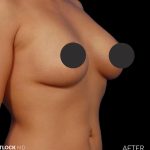 Breast Augmentation Before & After Patient #2754