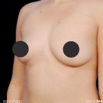 Breast Augmentation Before & After Patient #2755