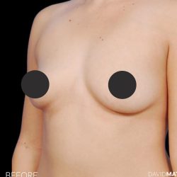 Breast Augmentation Before & After Patient #2755