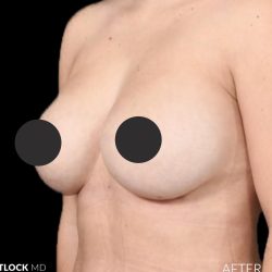 Breast Augmentation Before & After Patient #2755