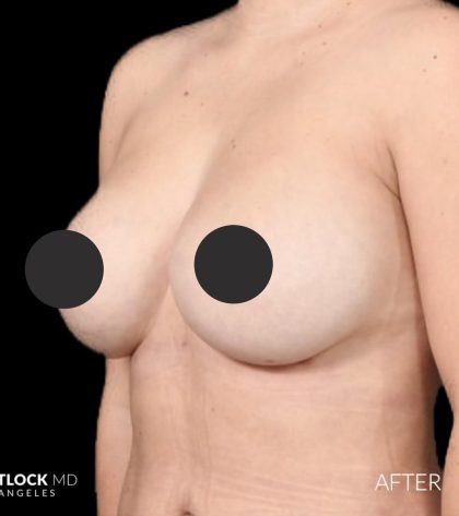 Breast Augmentation Before & After Patient #2755