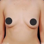 Breast Augmentation Before & After Patient #2755