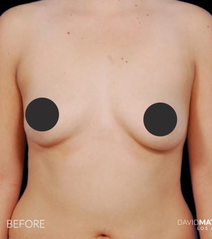 Breast Augmentation Before & After Patient #2755