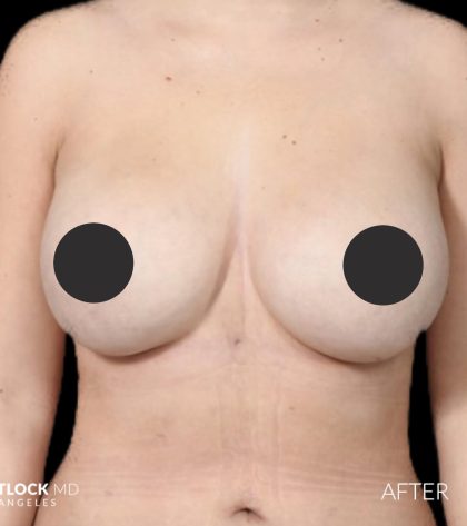 Breast Augmentation Before & After Patient #2755