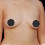 Breast Augmentation Before & After Patient #2755
