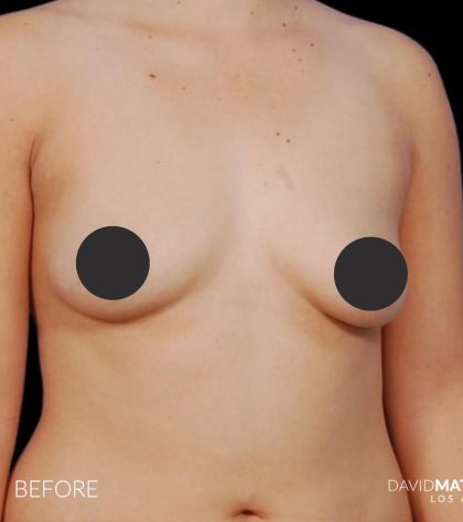 Breast Augmentation Before & After Patient #2755