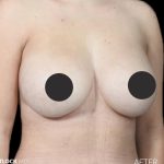 Breast Augmentation Before & After Patient #2755