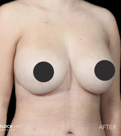 Breast Augmentation Before & After Patient #2755