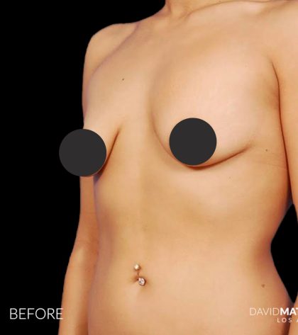 Breast Augmentation Before & After Patient #2756