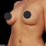 Breast Augmentation Before & After Patient #2756