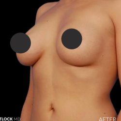 Breast Augmentation Before & After Patient #2756