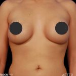 Breast Augmentation Before & After Patient #2756