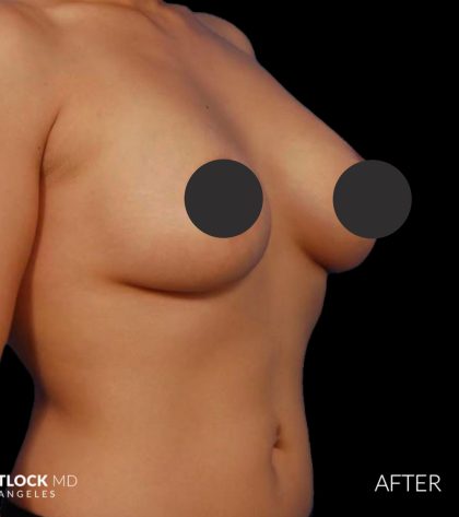 Breast Augmentation Before & After Patient #2756