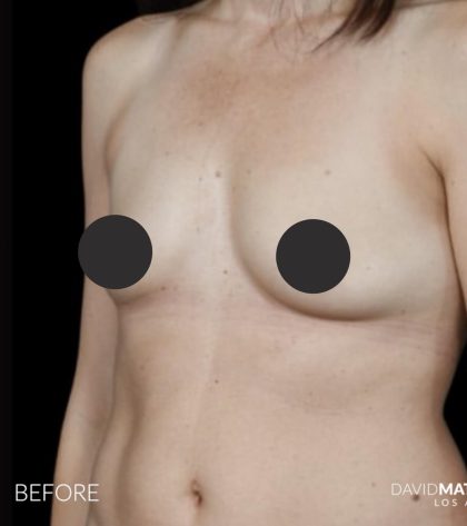 Breast Augmentation Before & After Patient #2757
