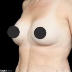 Breast Augmentation Before & After Patient #2757