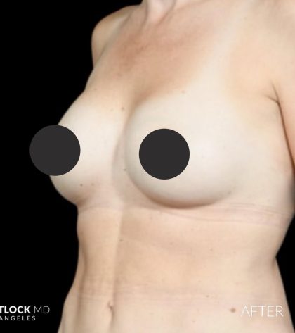 Breast Augmentation Before & After Patient #2757