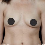 Breast Augmentation Before & After Patient #2757
