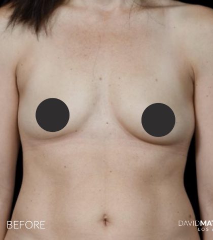 Breast Augmentation Before & After Patient #2757