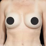 Breast Augmentation Before & After Patient #2757
