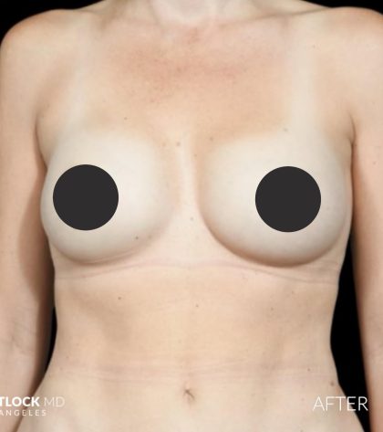 Breast Augmentation Before & After Patient #2757
