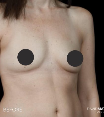 Breast Augmentation Before & After Patient #2757