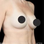 Breast Augmentation Before & After Patient #2757