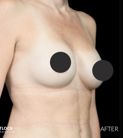 Breast Augmentation Before & After Patient #2757