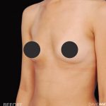 Breast Augmentation Before & After Patient #2758