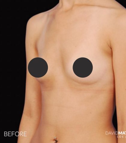 Breast Augmentation Before & After Patient #2758