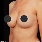 Breast Augmentation Before & After Patient #2758