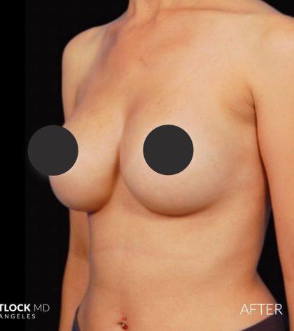 Breast Augmentation Before & After Patient #2758