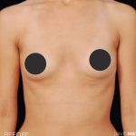 Breast Augmentation Before & After Patient #2758