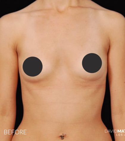 Breast Augmentation Before & After Patient #2758