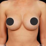Breast Augmentation Before & After Patient #2758