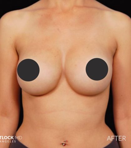 Breast Augmentation Before & After Patient #2758